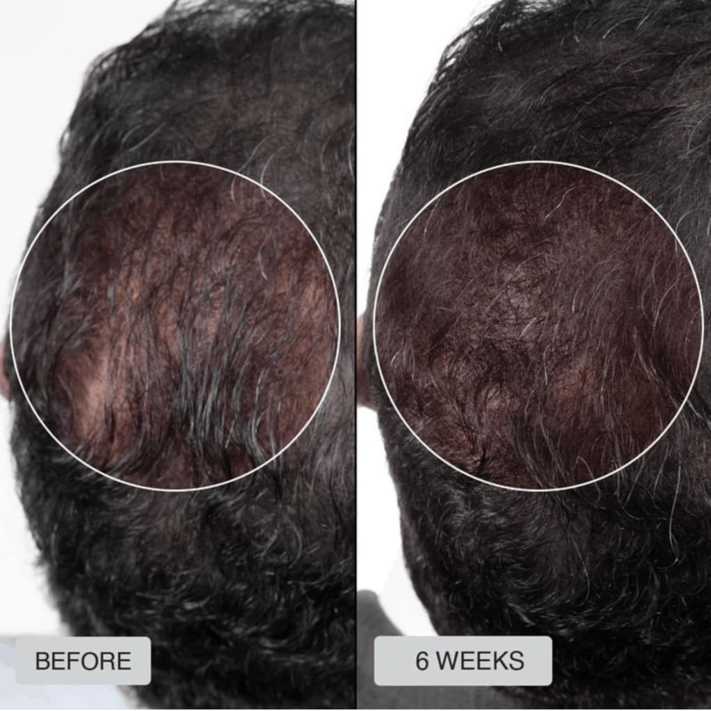 Infrared Growth Cap for Hair Regrowth Treatment