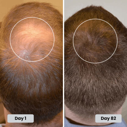 Infrared Growth Cap for Hair Regrowth Treatment